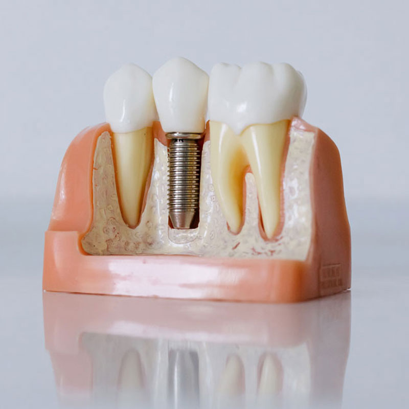 implantes dentales
