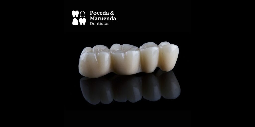 Prótesis dental fija de porcelana realizada en Ontinyent
